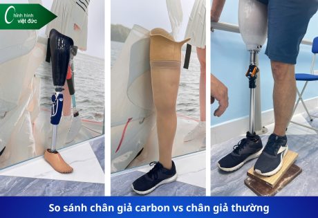 so sánh chân giả carbon và chân giả thường