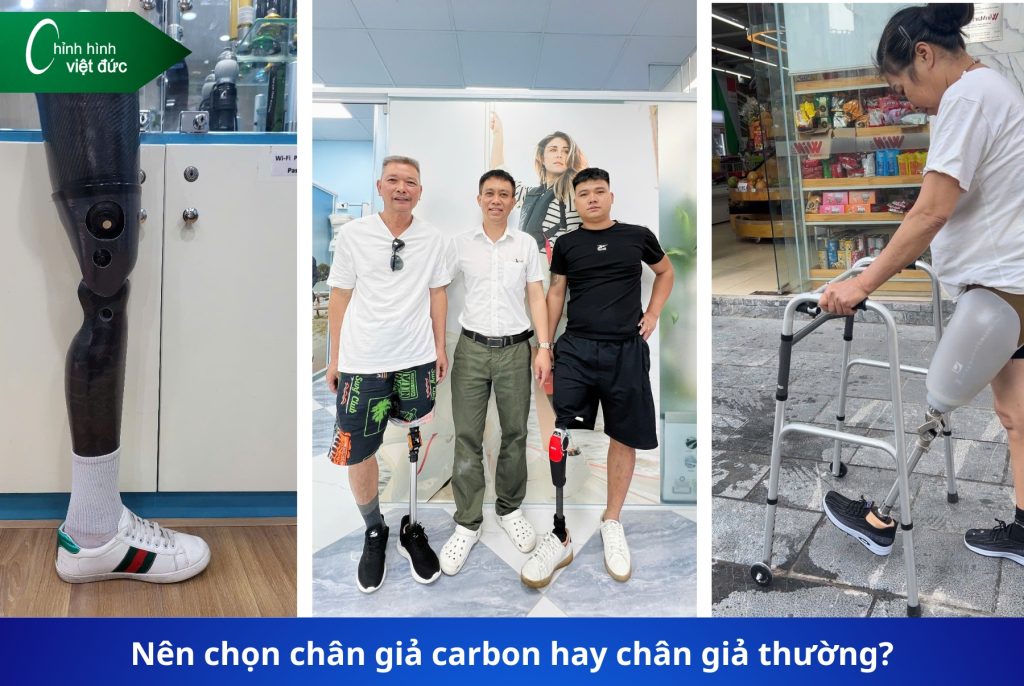 Chân giả carbon và chân giả thường 