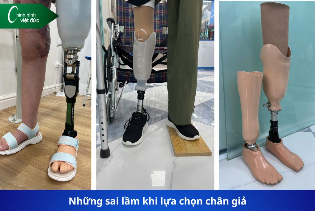 Chân giả carbon và chân giả thường 
