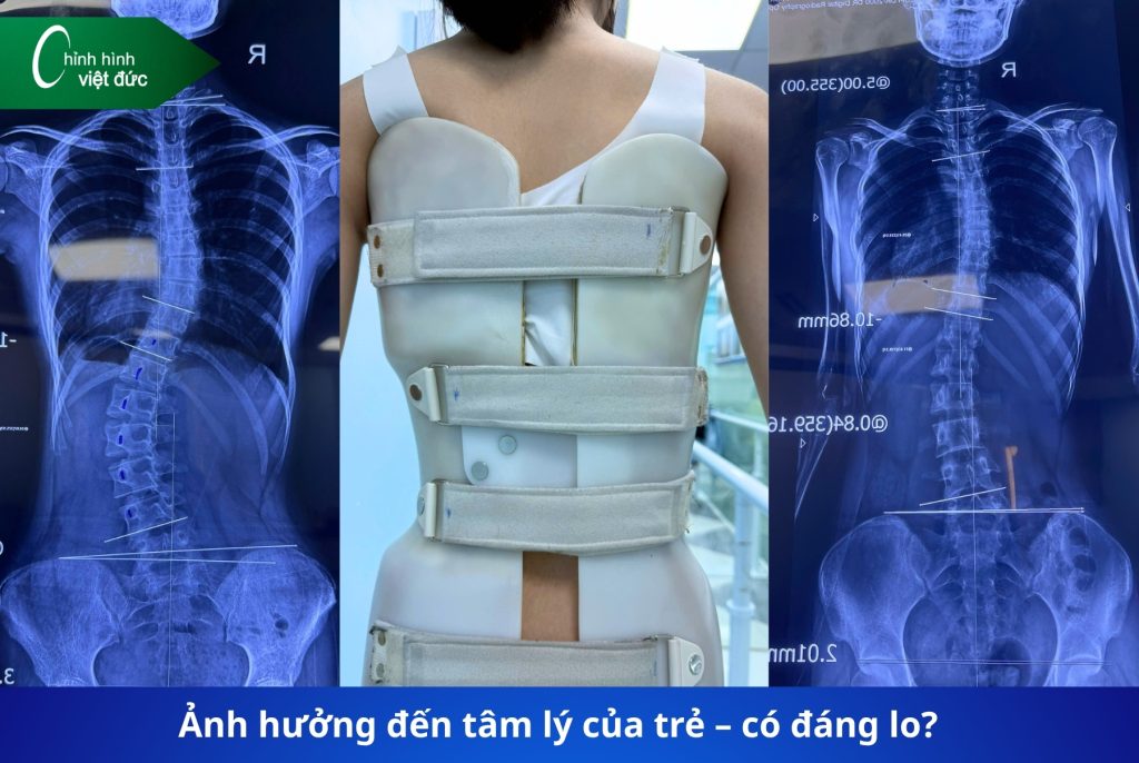 rẻ đeo áo chỉnh hình có ảnh hướng sinh hoạt học tập không