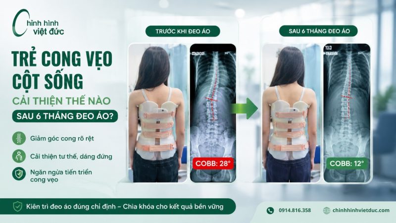 trẻ cong vẹo cột sống cải thiện thế nào