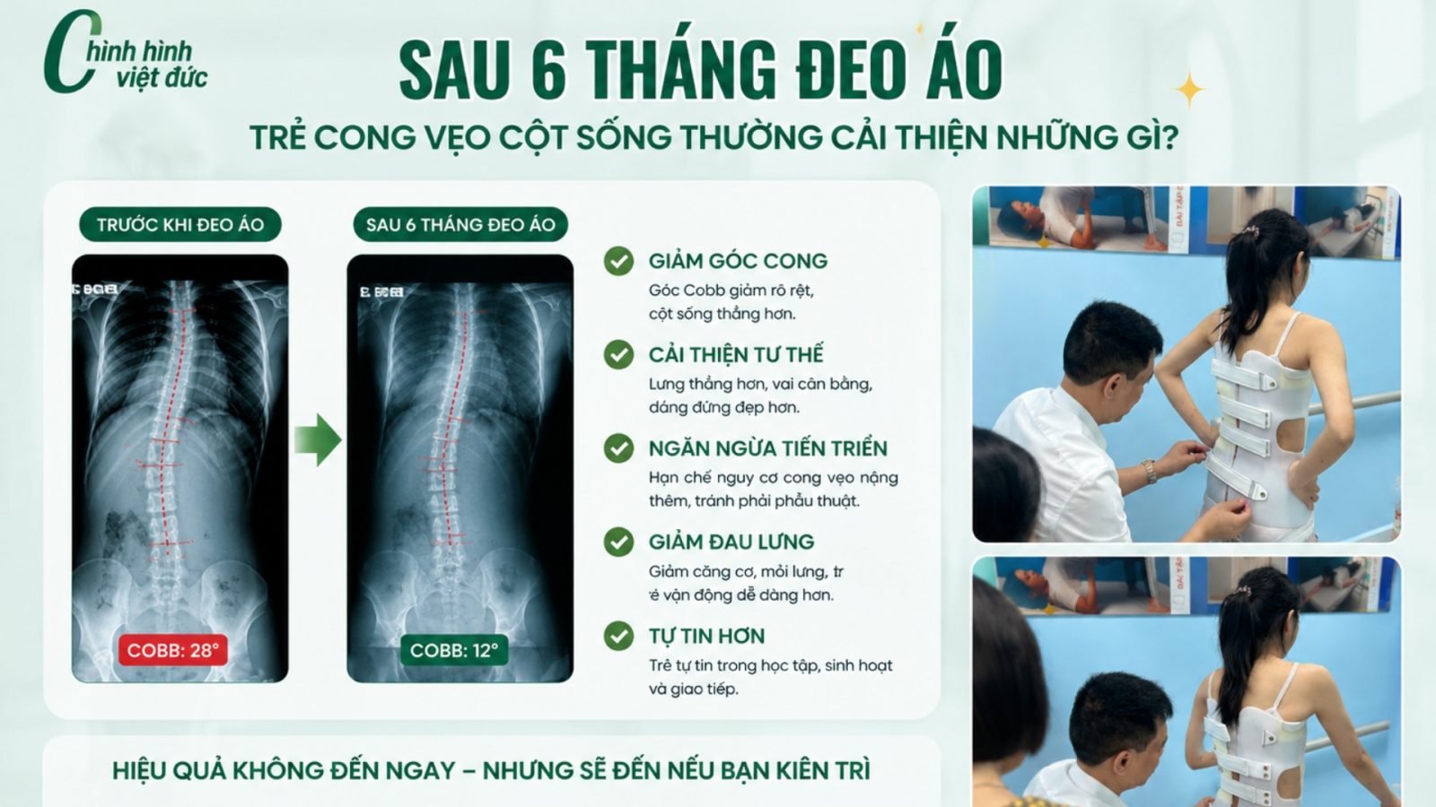 trẻ cong vẹo cột sống cải thiện thế nào