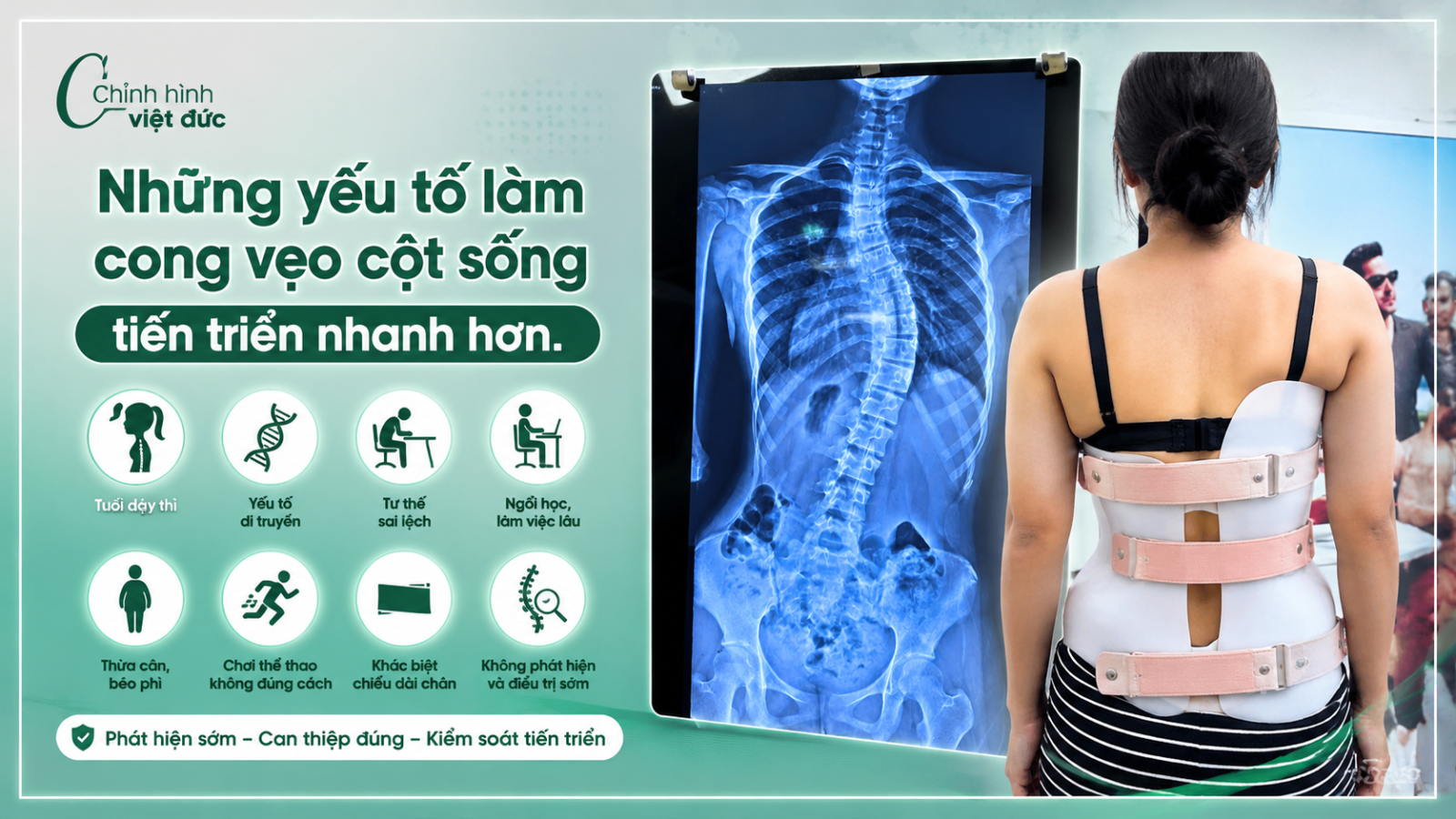 cong vẹo cột sống có thể tiến triển ra sao?