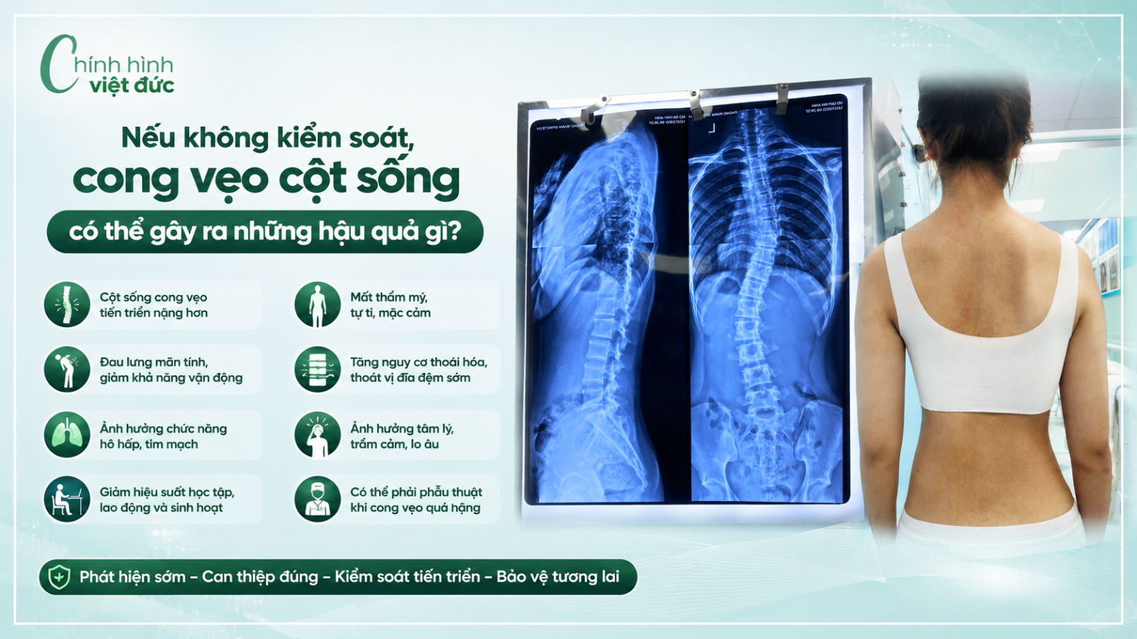 cong vẹo cột sống có thể tiến triển ra sao?