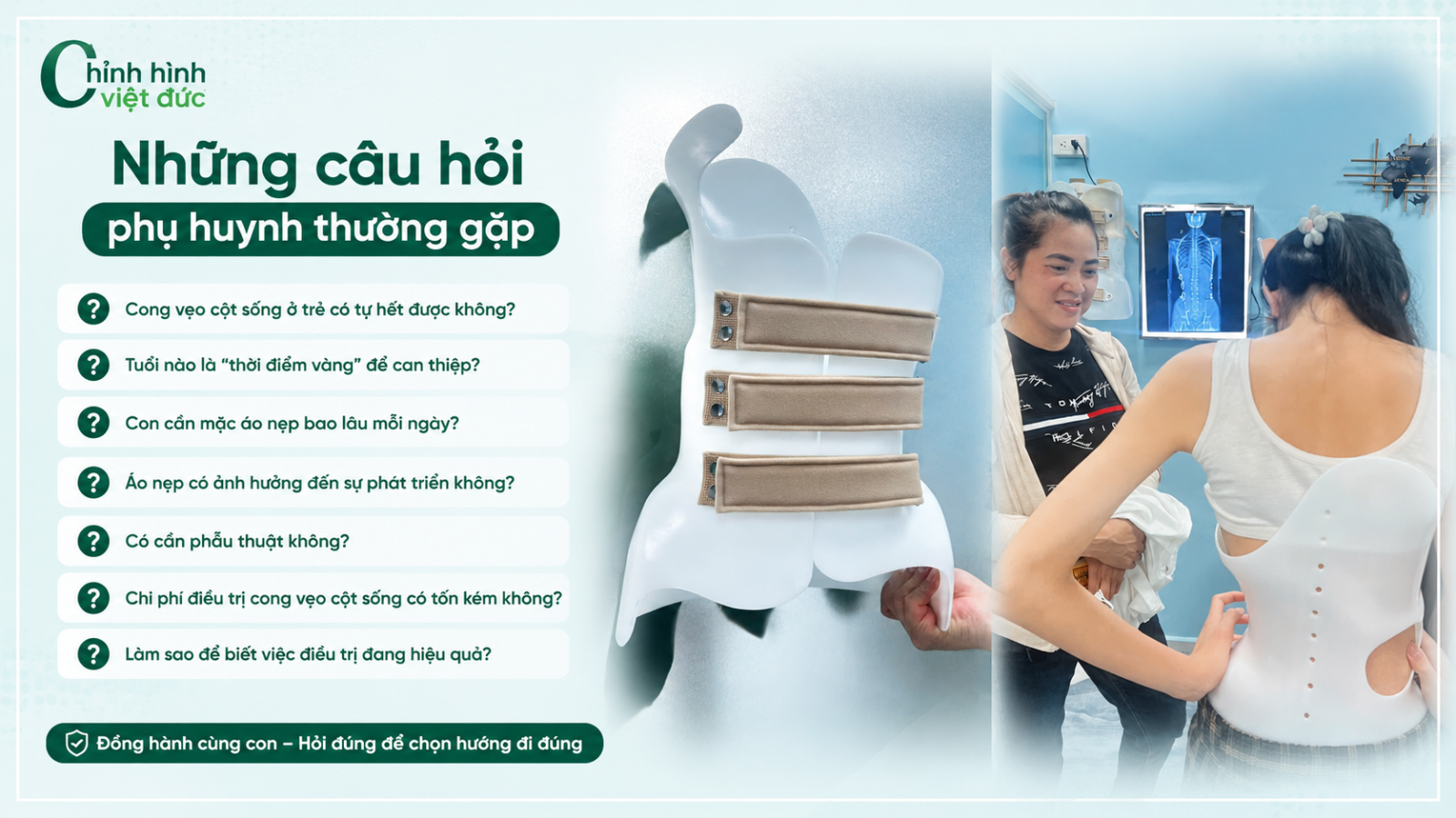 cong vẹo cột sống có thể tiến triển ra sao?