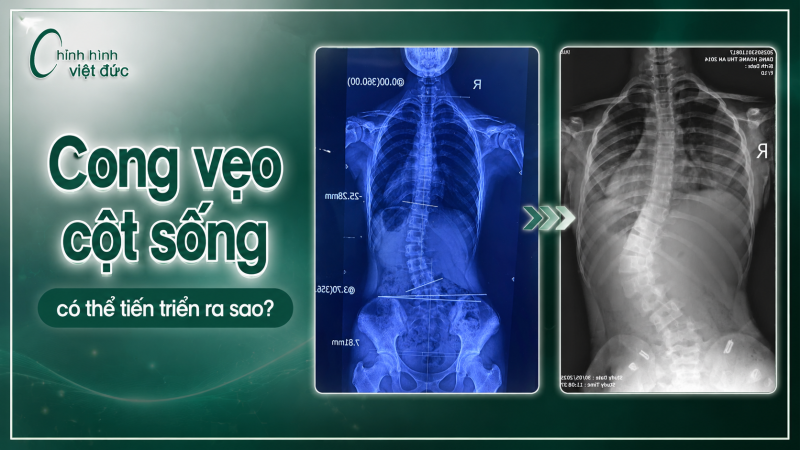 cong vẹo cột sống có thể tiến triển ra sao?