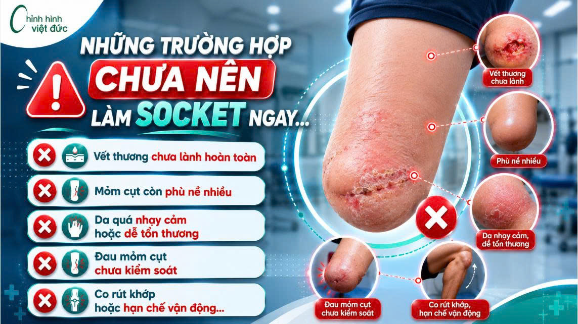 Mỏm cụt đủ điều kiện làm socket 