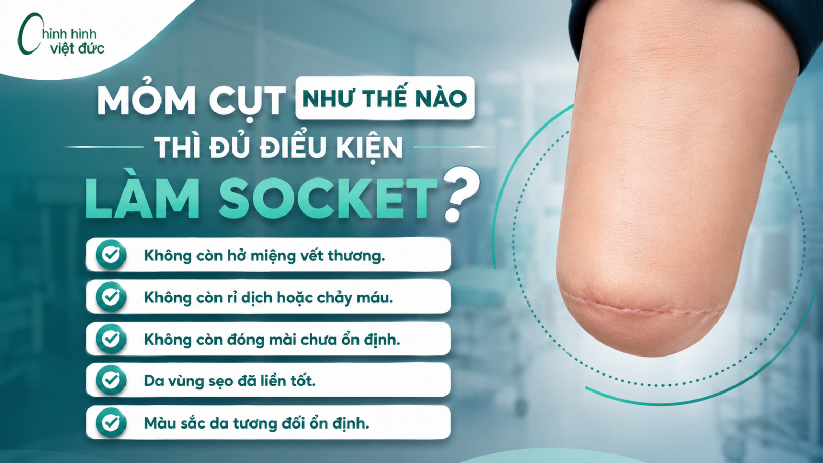 Mỏm cụt đủ điều kiện làm socket sẽ như thế nào