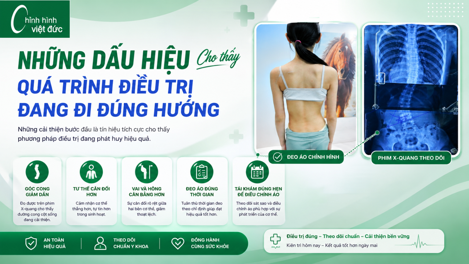 Đeo áo chỉnh hình thế nào để cải thiện