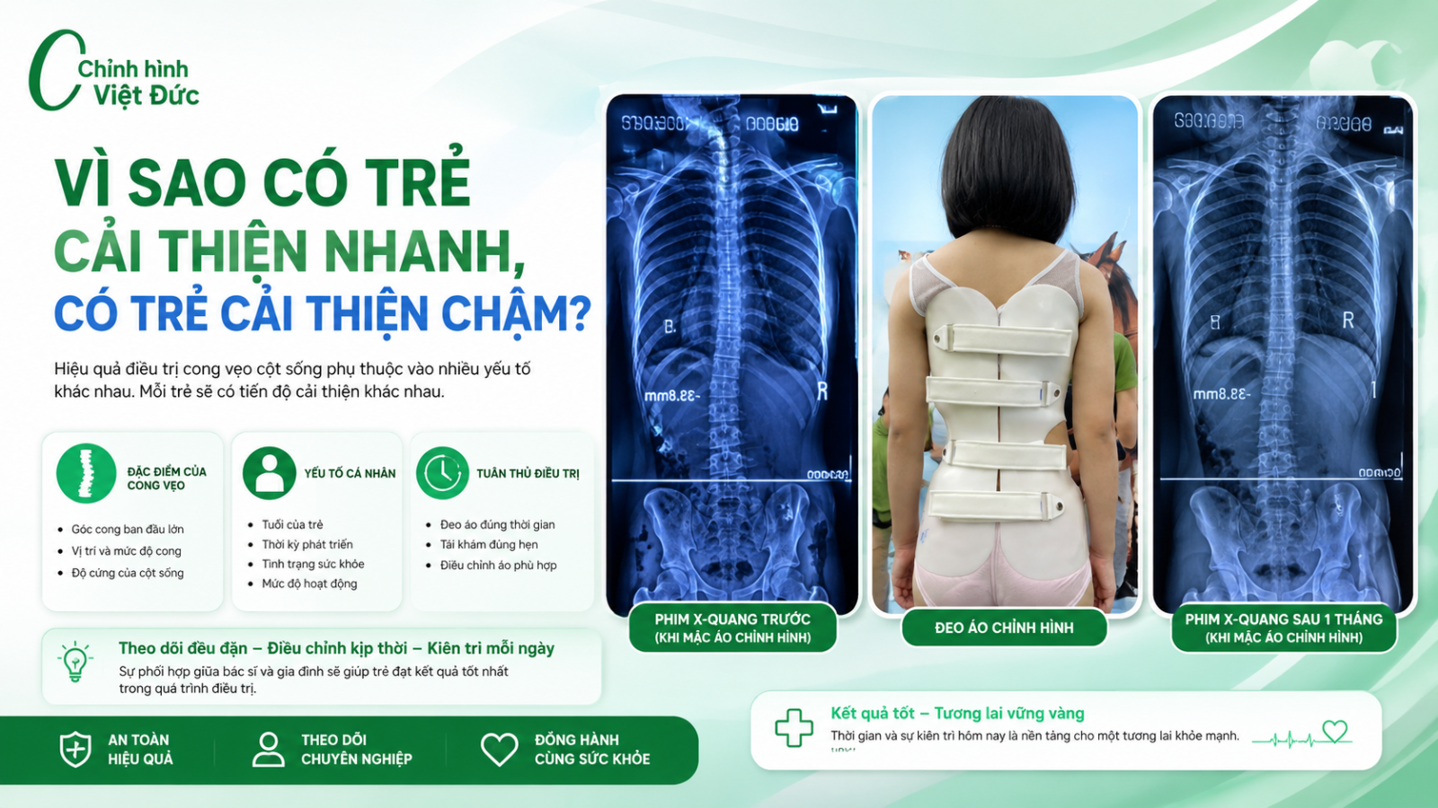 Đeo áo chỉnh hình thế nào để cải thiện