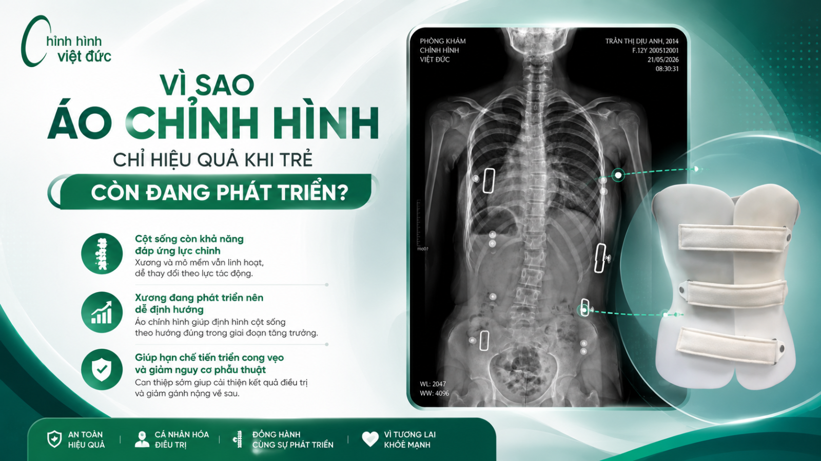 Độ tuổi vàng để can thiệp bằng áo chỉnh hình cong vẹo cột sống