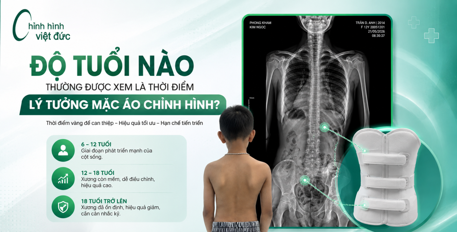 Độ tuổi vàng để can thiệp bằng áo chỉnh hình cong vẹo cột sống