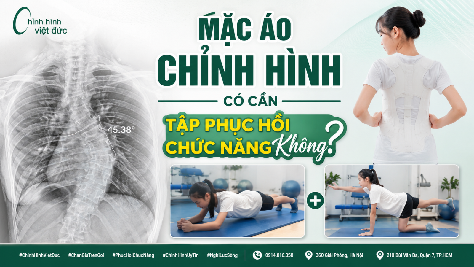 mặc áo chỉnh hình có cần tập phục hồi chức năng không