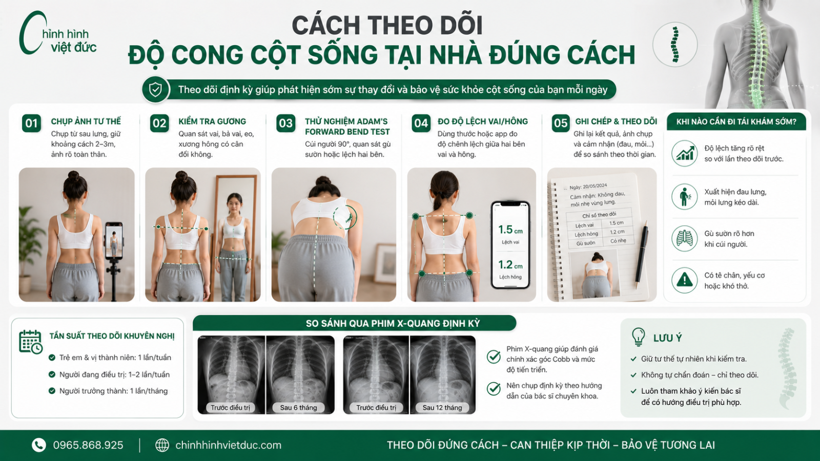 Cách theo dõi độ cong cột sống tại nhà