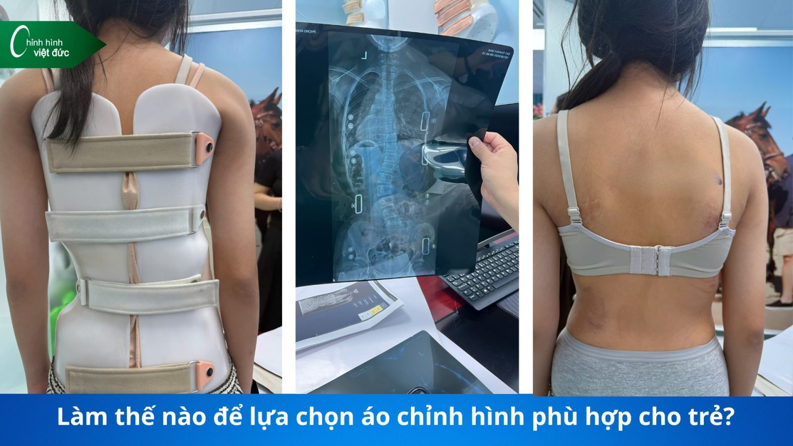 giá áo chỉnh cong vẹo cột sống