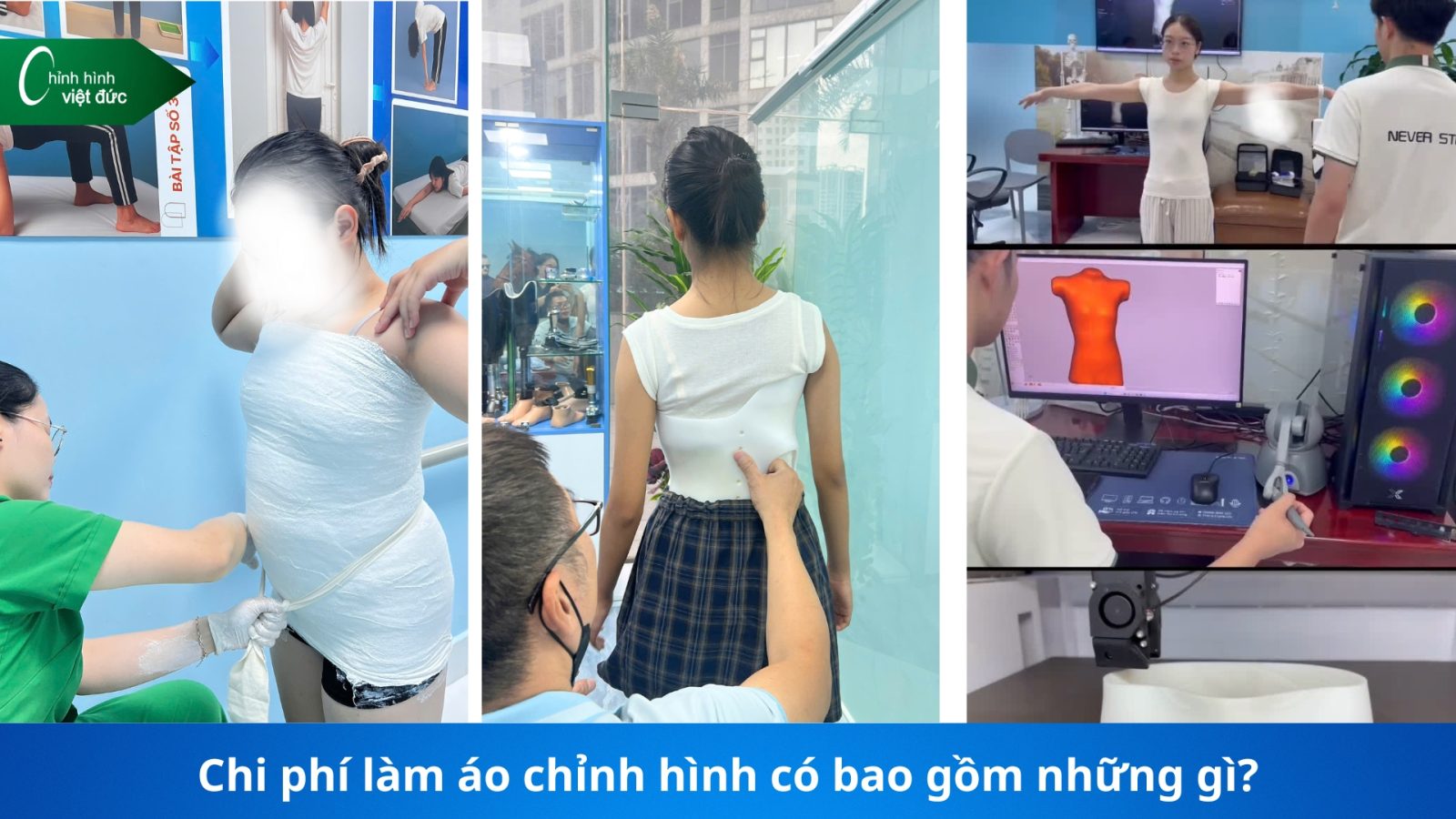 giá áo chỉnh cong vẹo cột sống