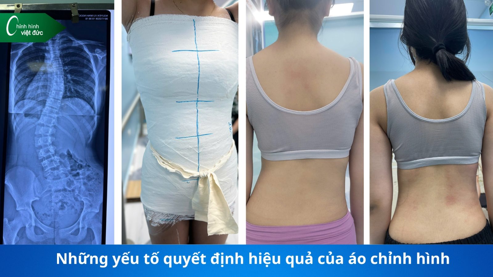 giá áo chỉnh cong vẹo cột sống