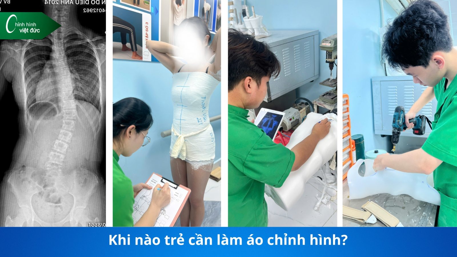 giá áo chỉnh cong vẹo cột sống