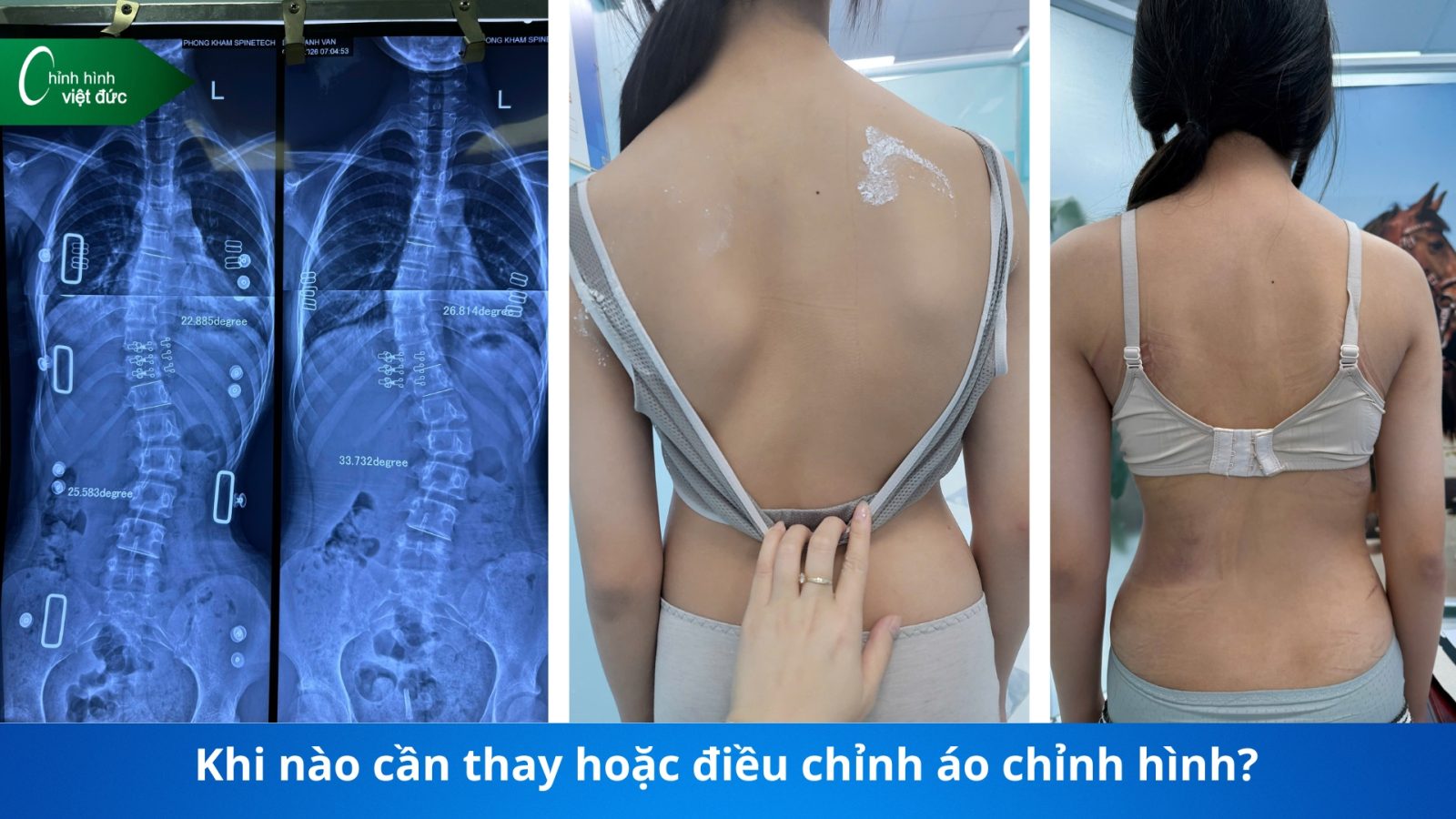 giá áo chỉnh cong vẹo cột sống