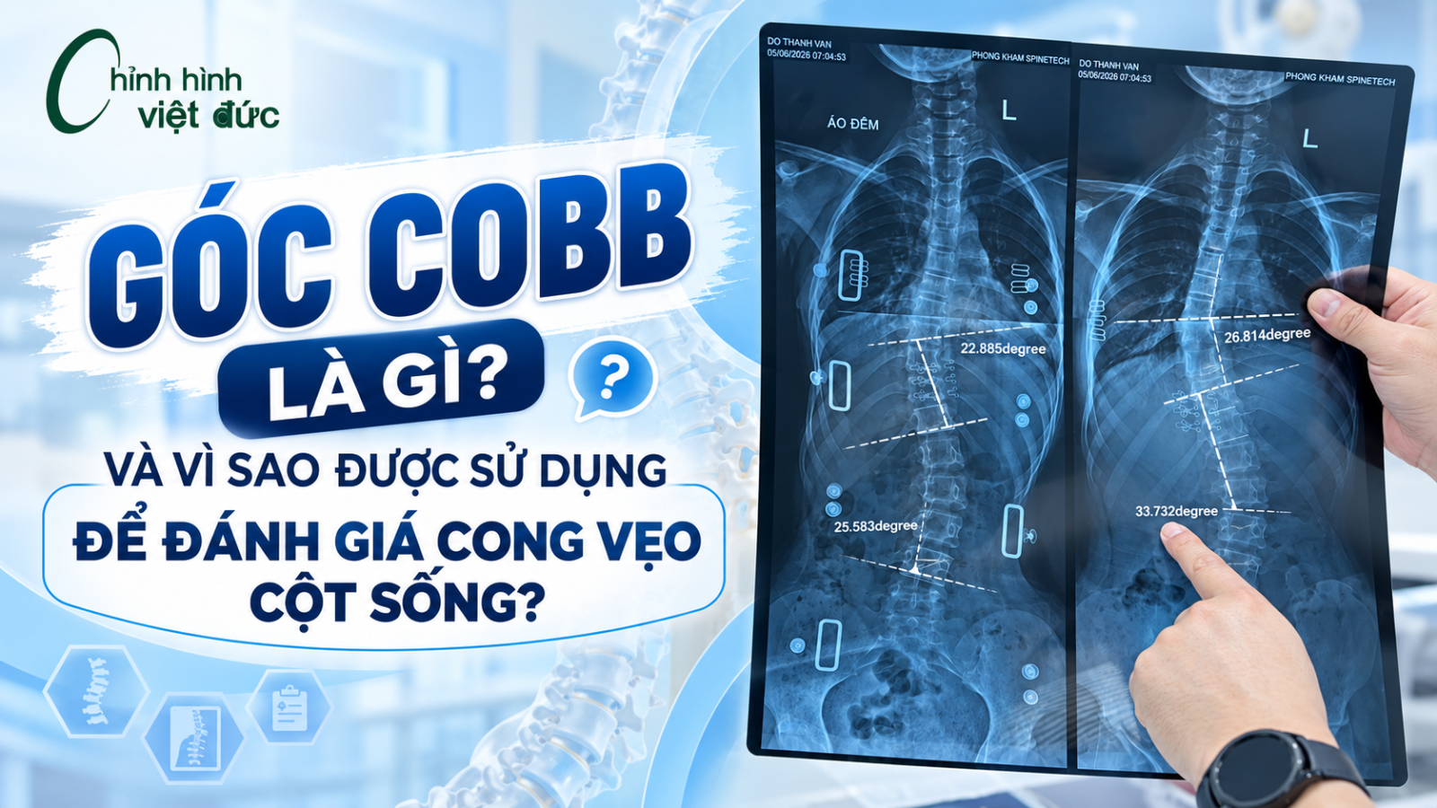 Góc Cobb giảm có phải là yếu tố duy nhất đánh giá hiệu quả?