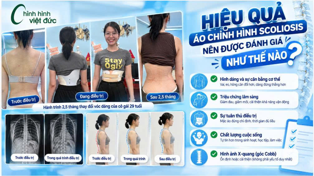 Góc Cobb giảm có phải là yếu tố duy nhất đánh giá hiệu quả?