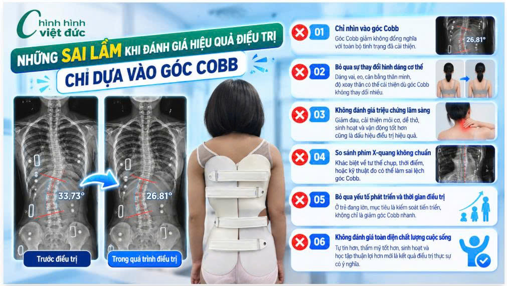 Góc Cobb giảm có phải là yếu tố duy nhất đánh giá hiệu quả?