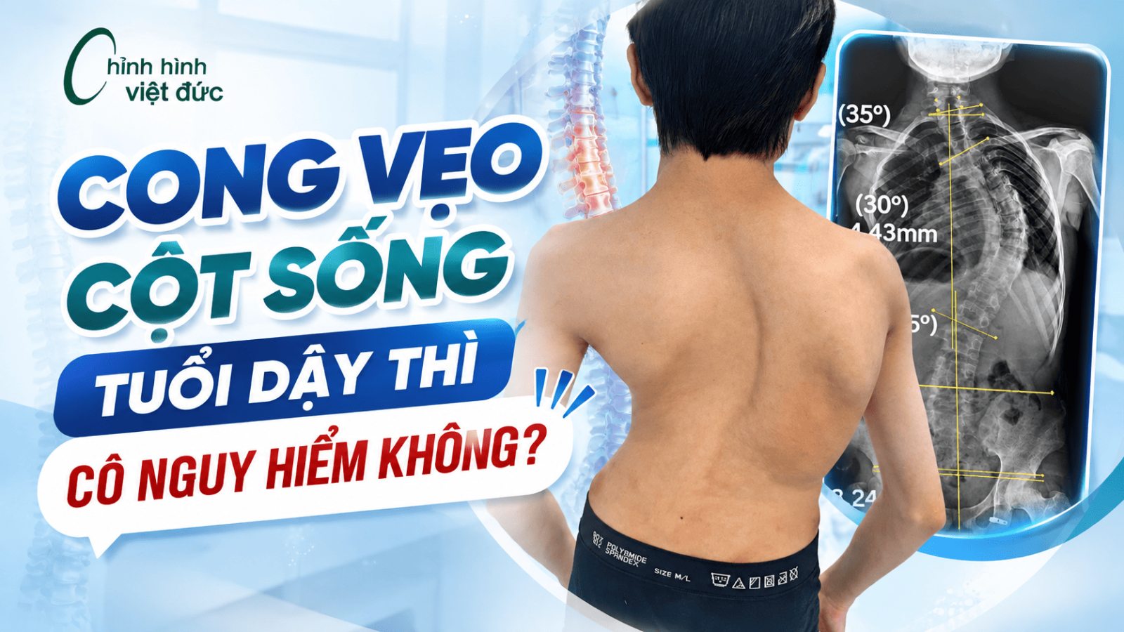Cong vẹo cột sống tuổi dậy thì