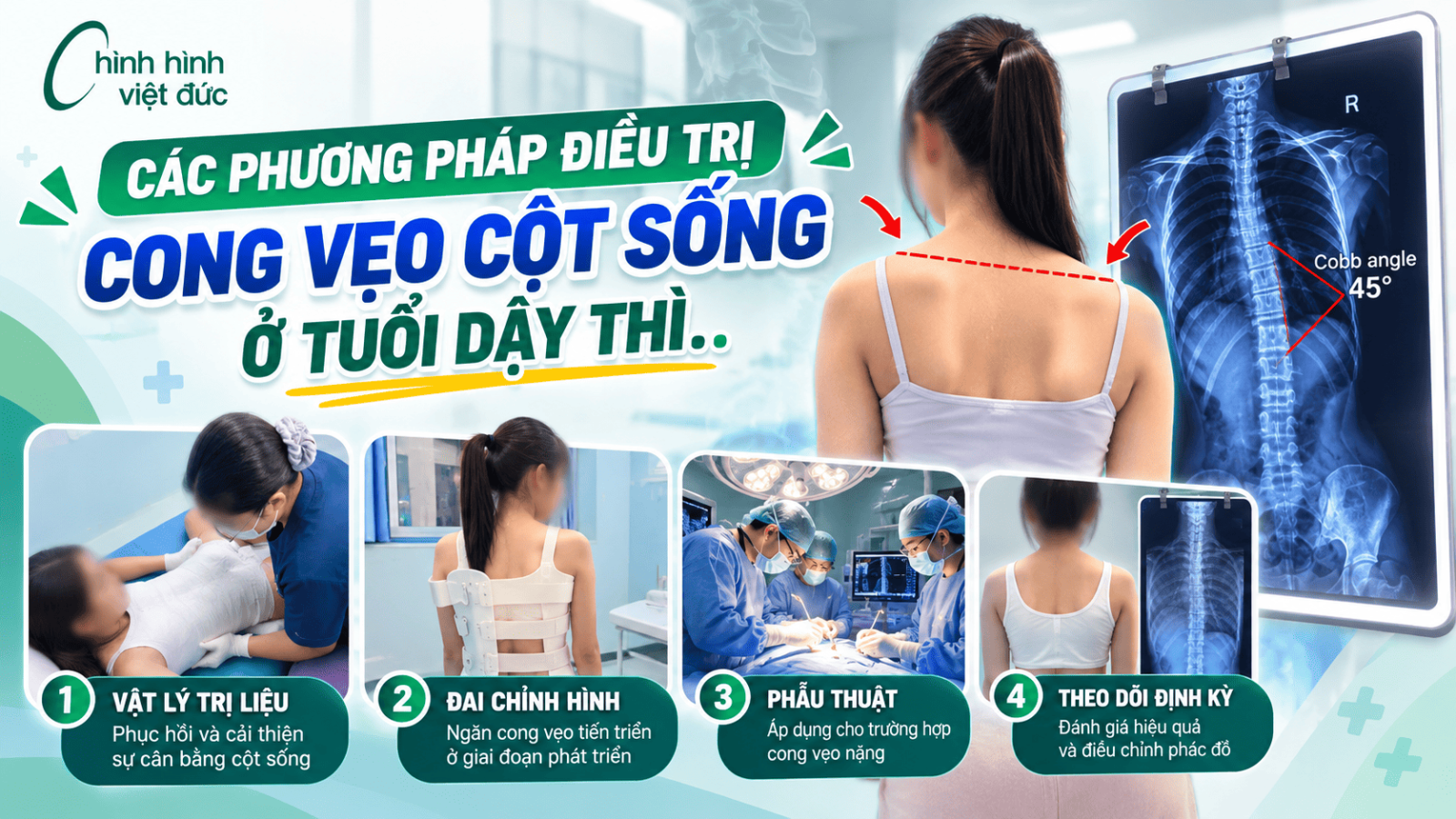 cong vẹo cột sống tuổi dậy thì