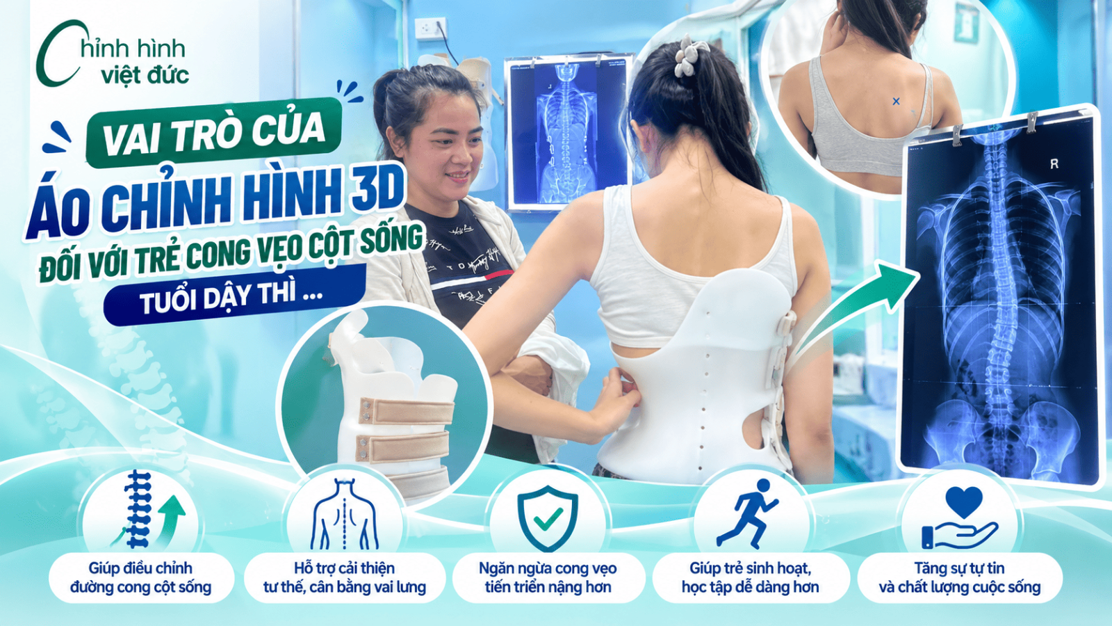 cong vẹo cột sống tuổi dậy thì