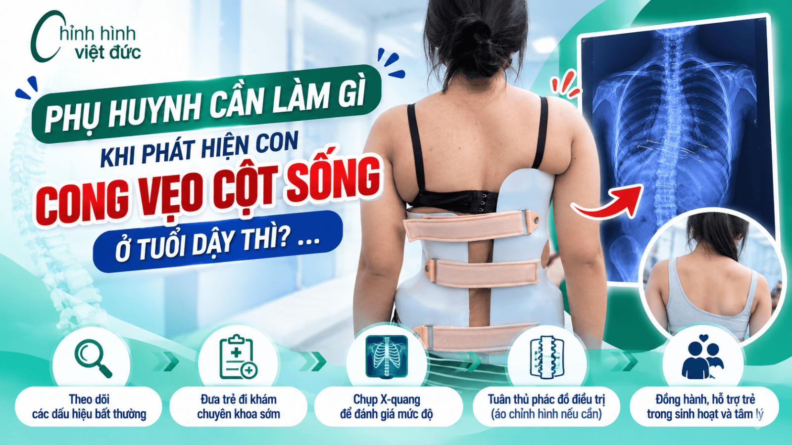 cong vẹo cột sống tuổi dậy thì
