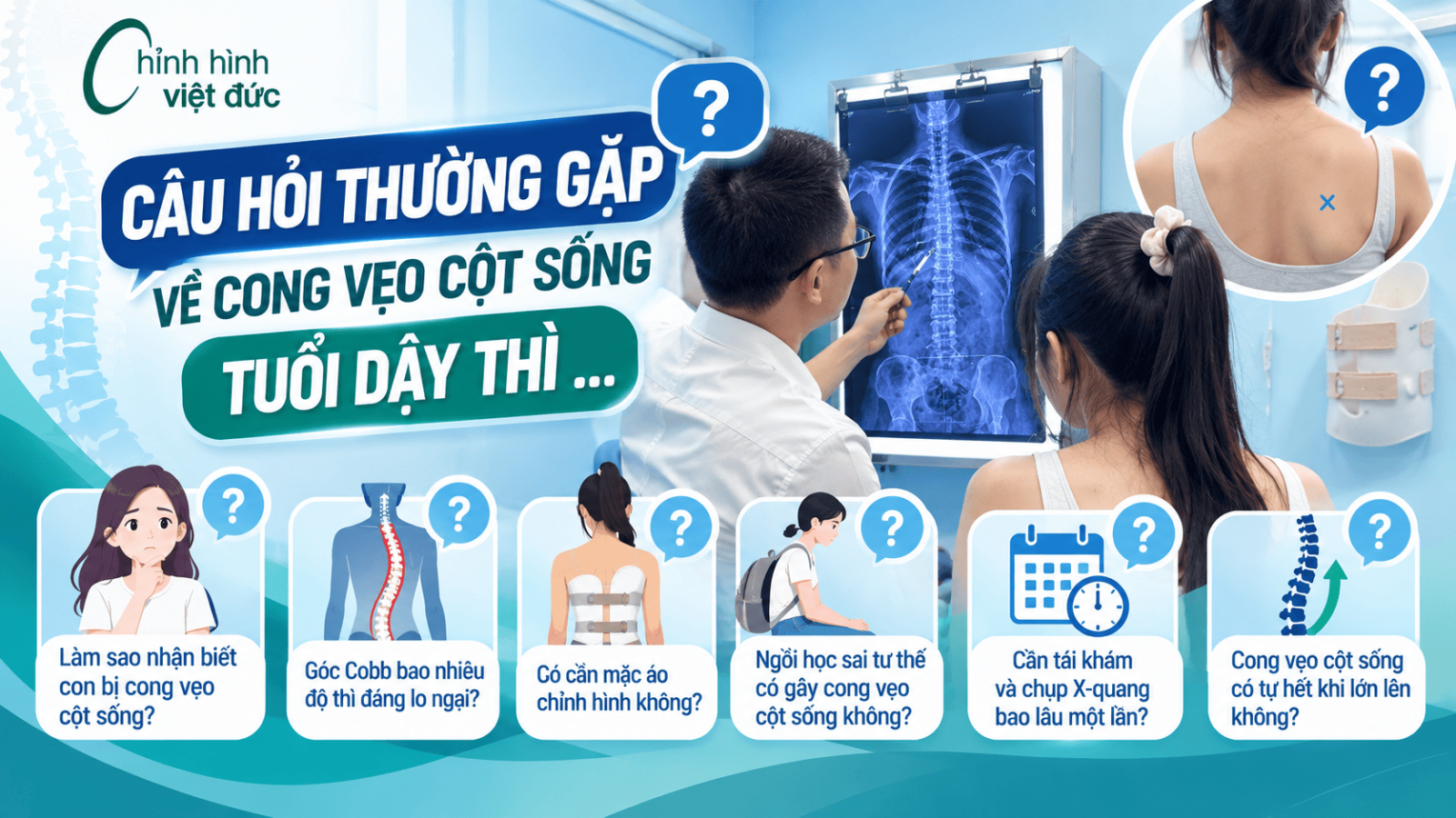 cong vẹo cột sống tuổi dậy thì