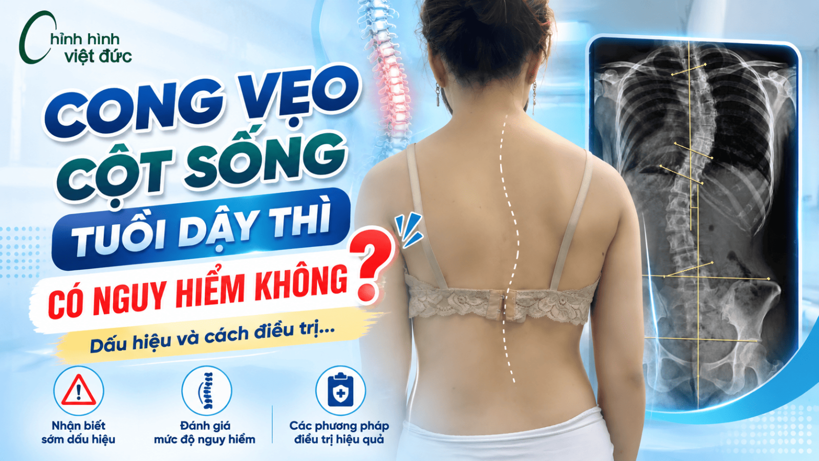Cong vẹo cột sống tuổi dậy thì