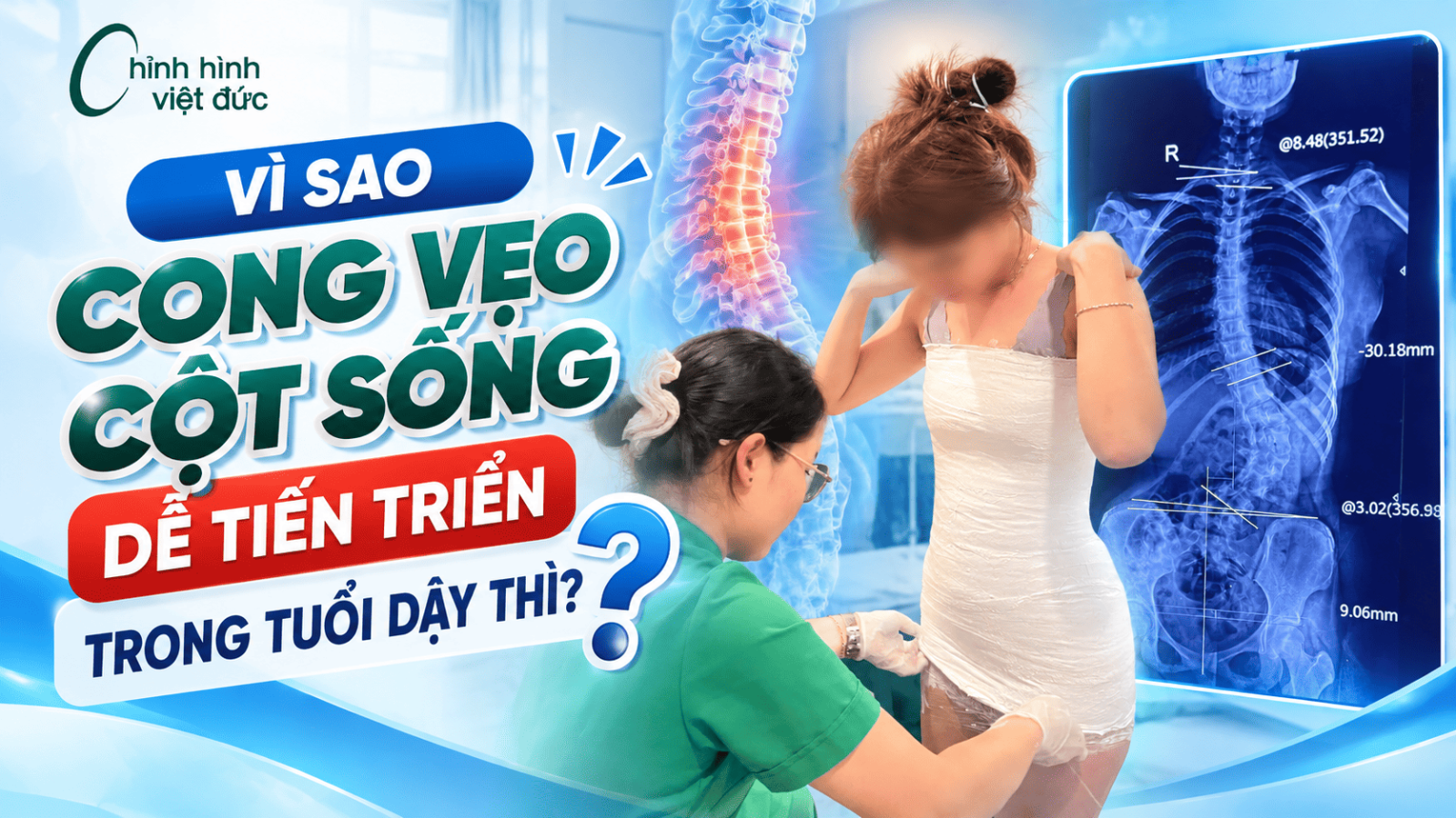 Cong vẹo cột sống tuổi dậy thì