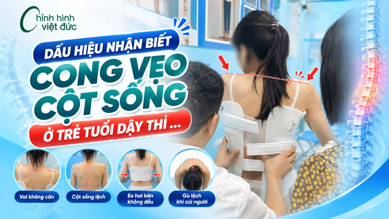cong vẹo cột sống tuổi dậy thì