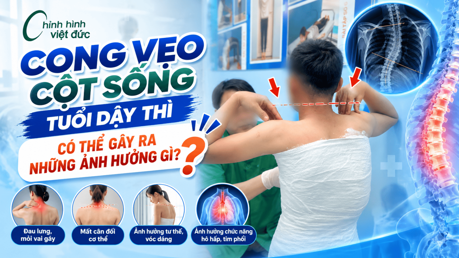 cong vẹo cột sống tuổi dậy thì