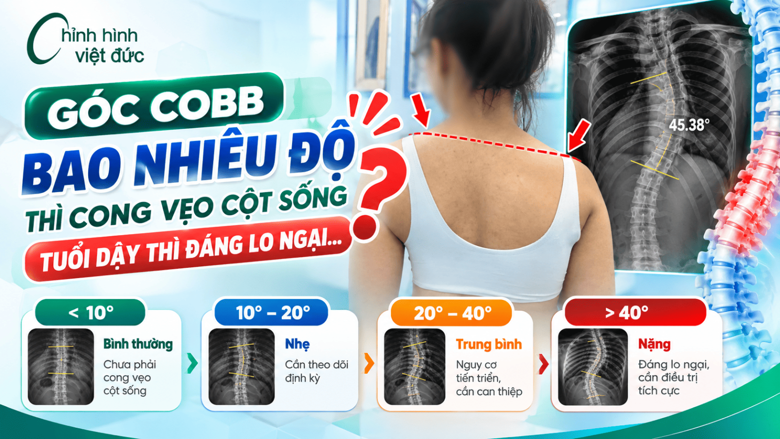 cong vẹo cột sống tuổi dậy thì