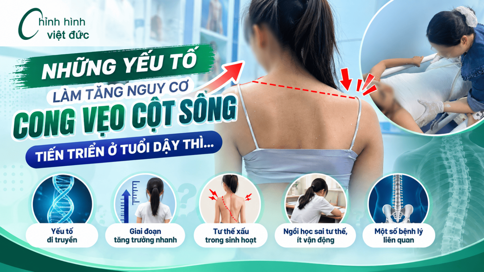 cong vẹo cột sống tuổi dậy thì