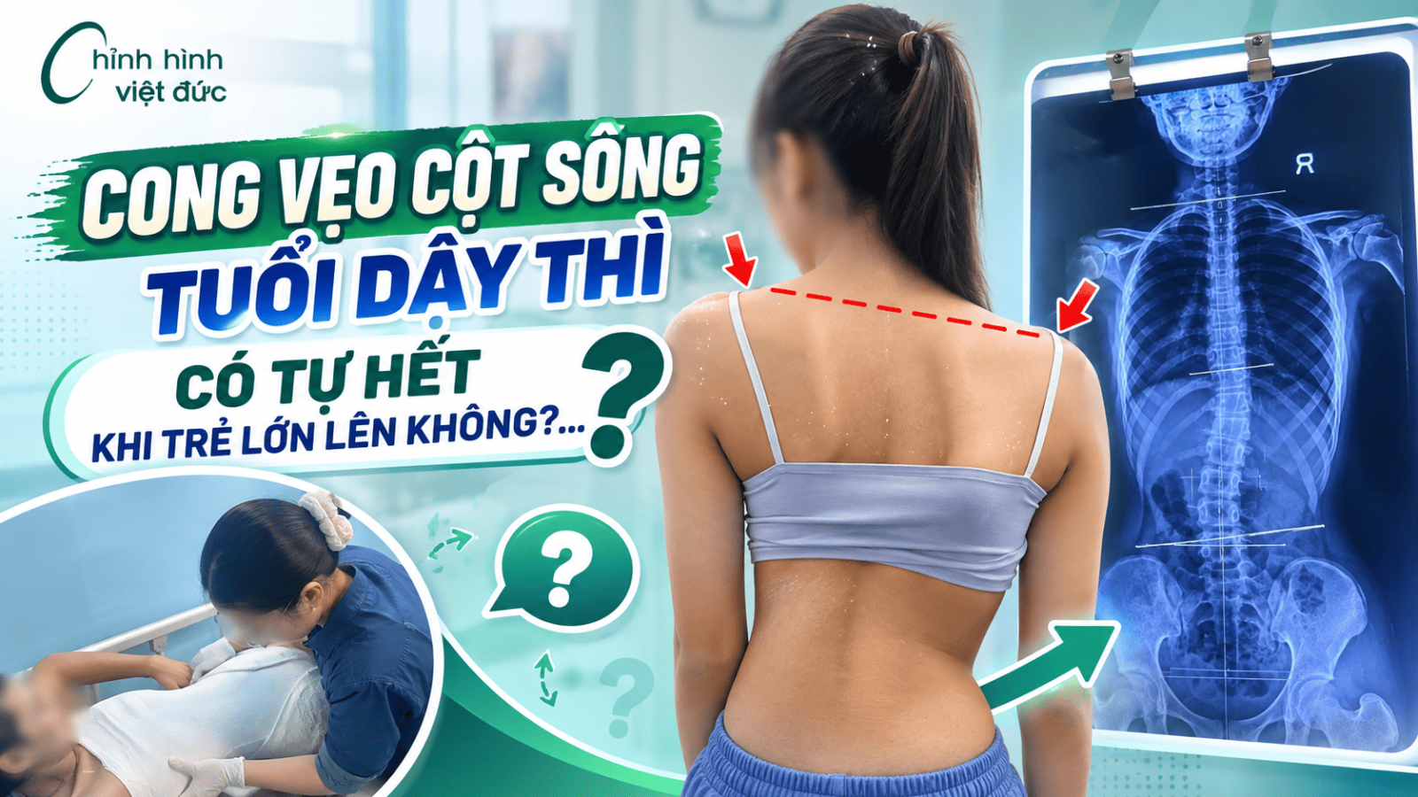 cong vẹo cột sống tuổi dậy thì