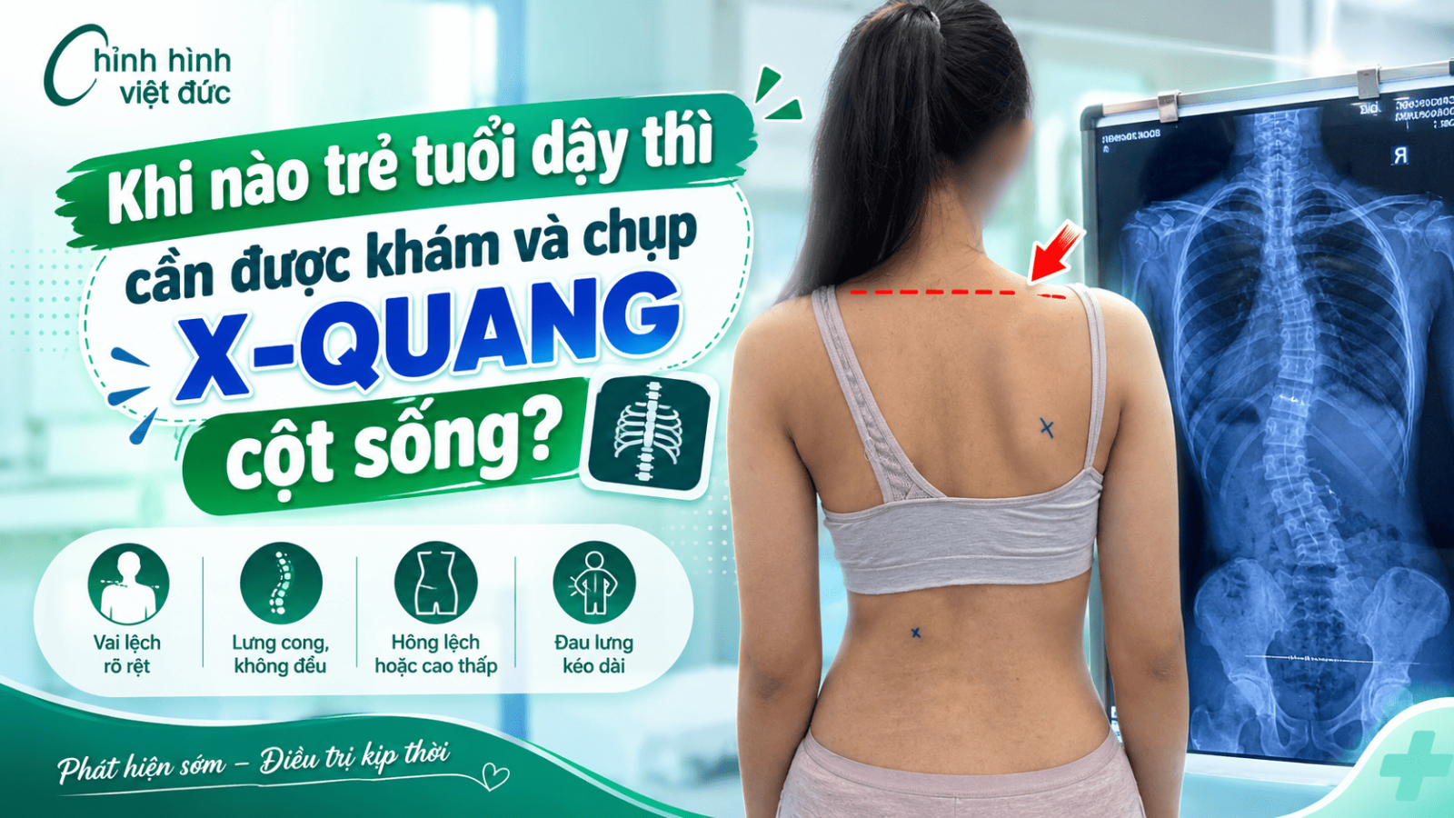 cong vẹo cột sống tuổi dậy thì