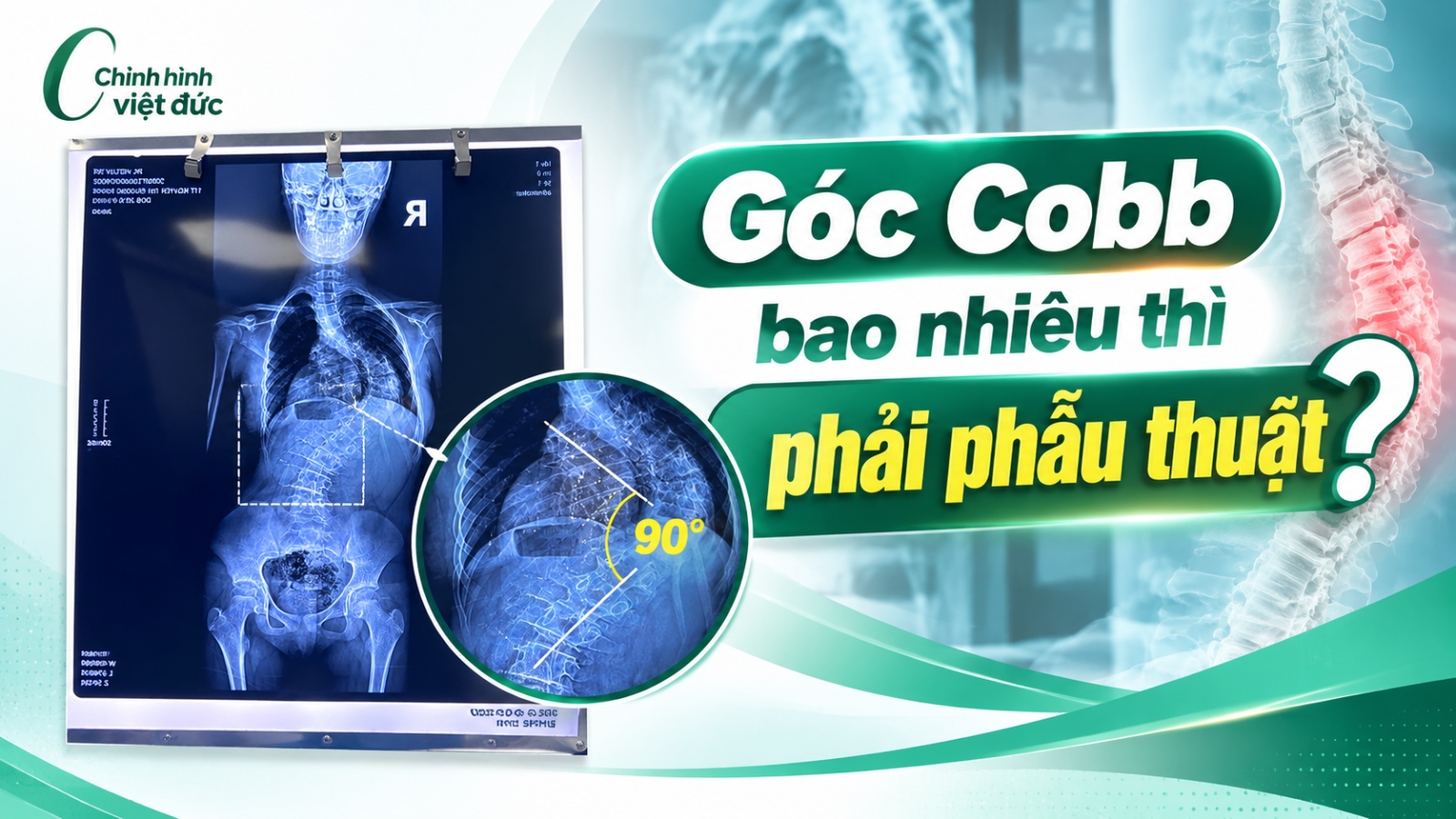 Khi nào phải phẫu thuật cong vẹo cột sống thay vì đeo áo chỉnh hình?
