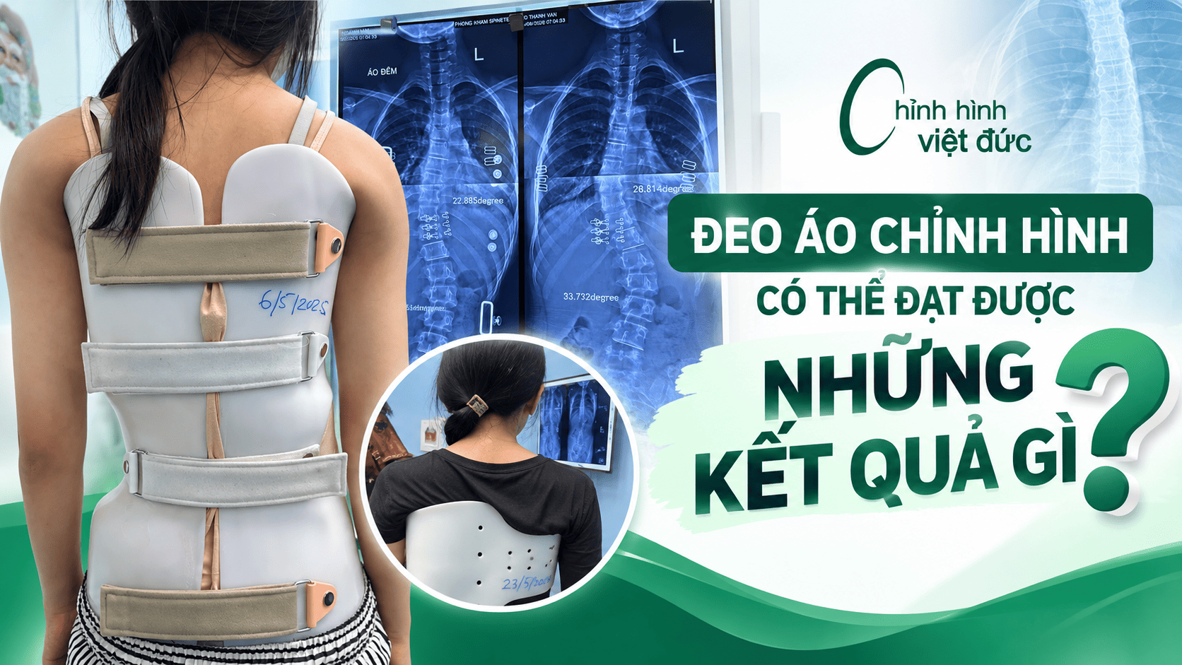 mặc áo chỉnh hình có chữa khỏi hoàn toàn cong vẹo cột sống